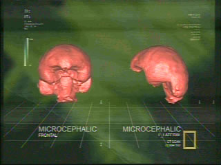 Microcephalic Brain CT Scan