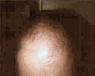 male pattern baldness